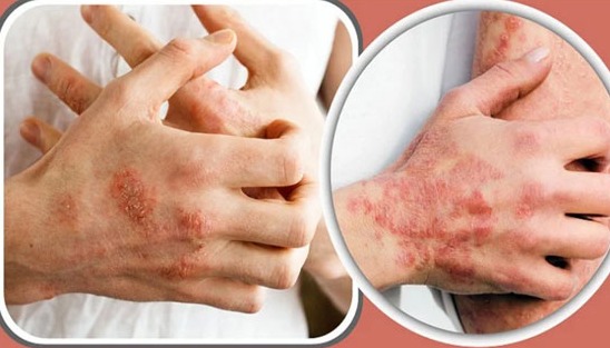 শীতকালীন চর্মরোগে করণীয়