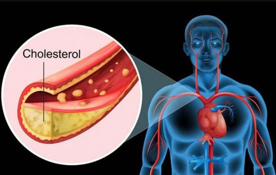 কোলেস্টেরল নিয়ন্ত্রণে বাদ দিতে হবে যেসব খাবার