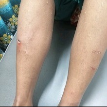 হোসেনপুরে কুকুরের কামড়ে আহত অর্ধশতাধিক