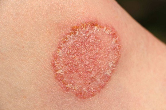 ফাঙ্গাস ইনফেকশনে আক্রান্ত হলে যা করণীয়