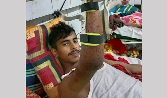 যন্ত্রণায় কাতরাচ্ছেন বৈষম্যবিরোধী আন্দোলনে হাসান সরদার