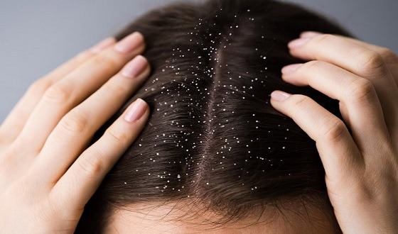 খুশকি দূর করার ঘরোয়া উপকরন