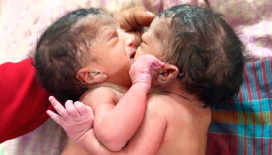 ধামইরহাটে জোড়া পেটের জমজ কন্যা শিশু প্রসব, আর্থিক সহায়তা চায় পরিবার