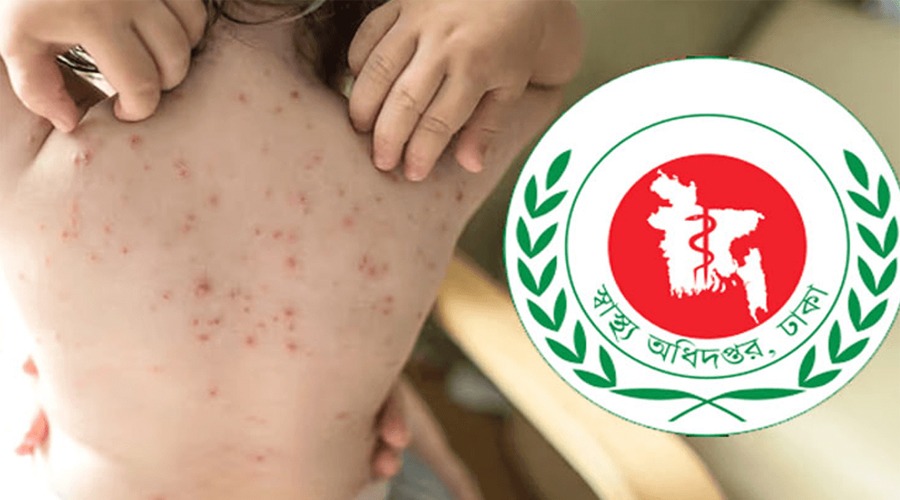 হামের উপসর্গে আরও ৫ জনের মৃত্যু