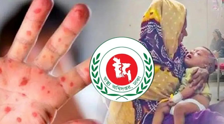 হামে বাড়ছে মৃত্যু, একদিনে প্রাণ গেল আরও ১১ শিশুর