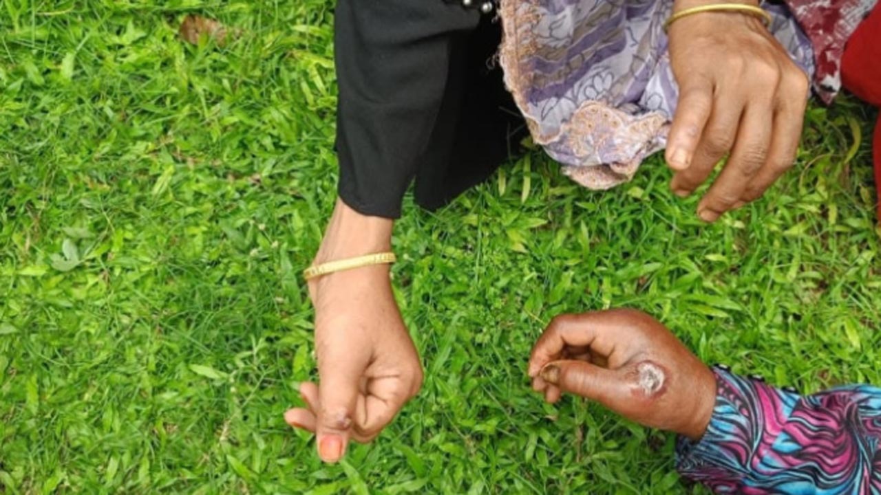 দেশে অ্যানথ্রাক্স ছড়িয়ে পড়ার শঙ্কা বাড়ছে