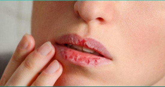 ঠোঁট ফাটা জটিল রোগের লক্ষণ