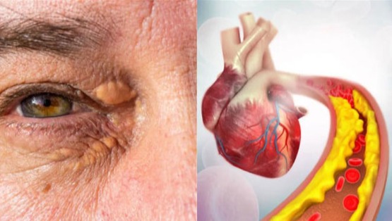 যে লক্ষণে বুঝবেন শরীরে কোলেস্টেরলের মাত্রা বেশি