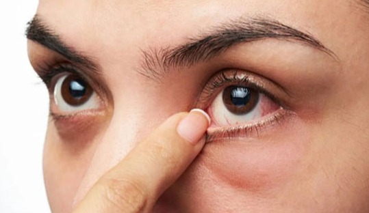 শীতে ড্রাই আই'র সমস্যা কমাতে করণীয়