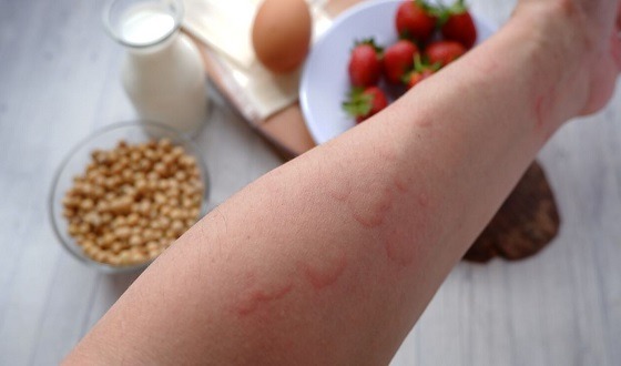 খাবারে অ্যালার্জির সমস্যায় যা করবেন