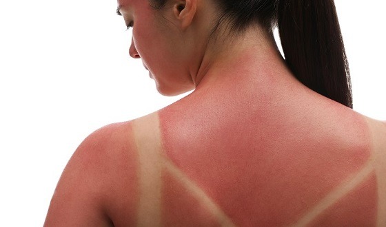 রোদে পোড়া ত্বক উজ্জল করবেন যেভাবে