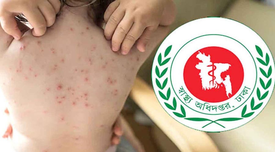 হামের উপসর্গে আরও ২ শিশুর মৃত্যু, মোট প্রাণহানি ৮৮০