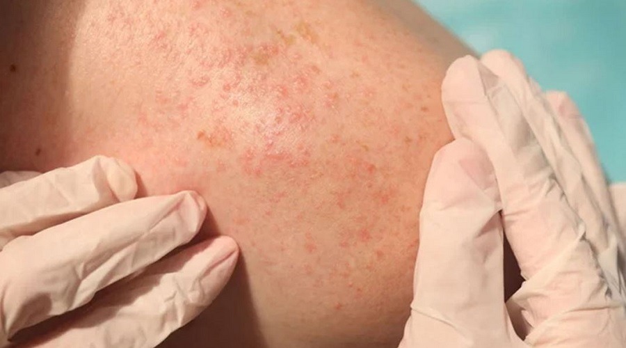 গরমে ঘামাচি থেকে মুক্তির সহজ উপায়